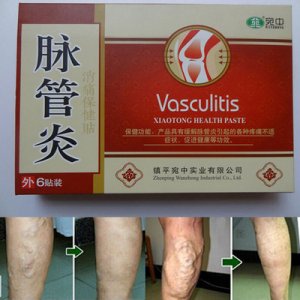 風(fēng)濕脈管炎貼OEM代加工